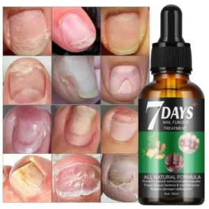 Nail Fungus Repair Serum 7-Day Treatment (30ml) – Best Nail Fungus Serum Price in Pakistan