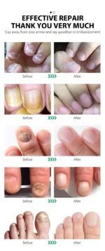 Best Nail Fungus Serum Price in Pakistan – 7 Day Treatment (30ml) - Image 10